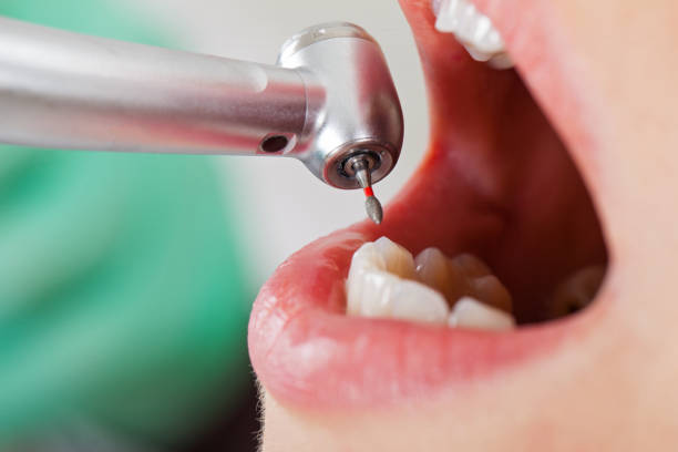 Best Emergency Wisdom Teeth Removal in Middlesex, NJ